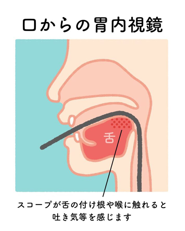 【画像】口からの胃内視鏡