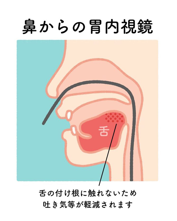 【画像】鼻からの胃内視鏡